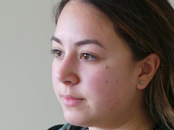 Rhinoplasty Patient 33 After 2