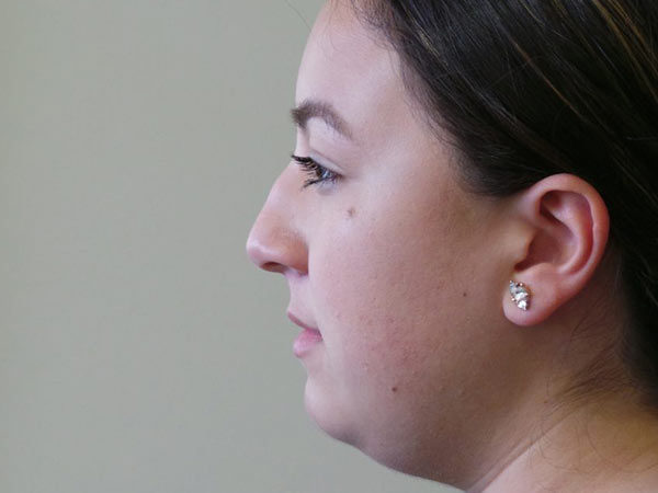 Rhinoplasty Patient 33 Before 1