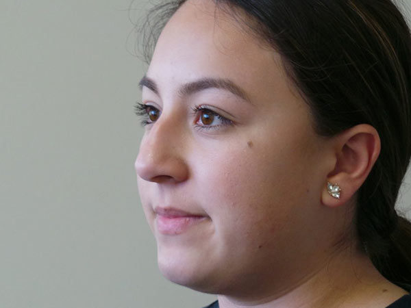 Rhinoplasty Patient 33 Before 2