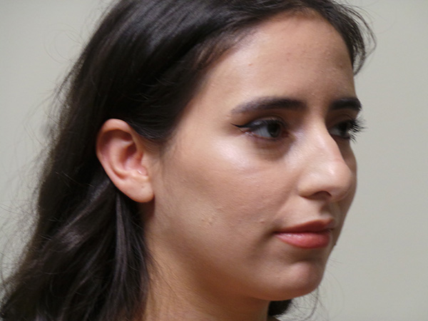 Rhinoplasty Patient 34 Before 2