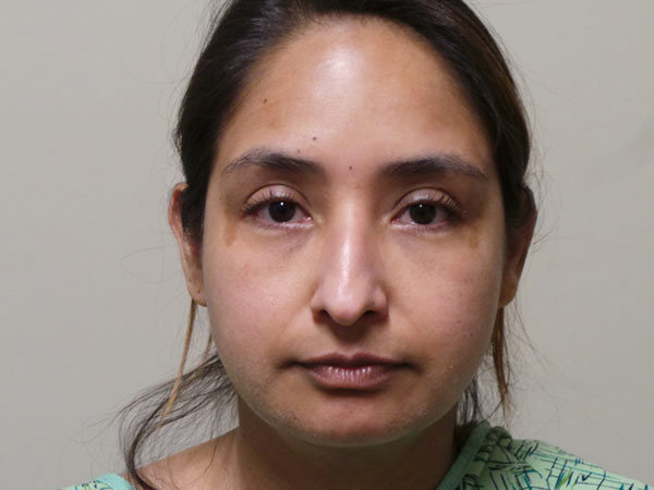 Rhinoplasty Patient 01 Before 1