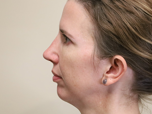 Rhinoplasty Patient 35 After 2