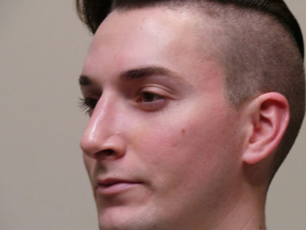 Rhinoplasty Patient 03 After 1