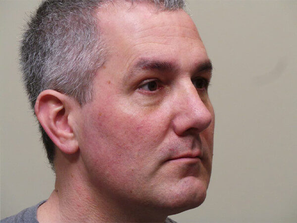 RHINOPLASTY PATIENT 15 After 1