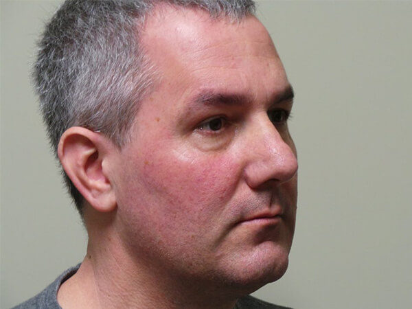 RHINOPLASTY PATIENT 15 Before 1