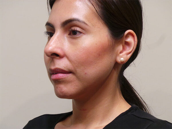 RHINOPLASTY PATIENT 02 Before 1