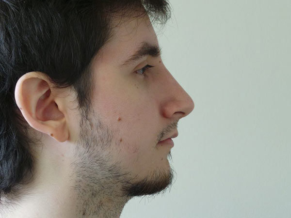Rhinoplasty Patient 21 After 1
