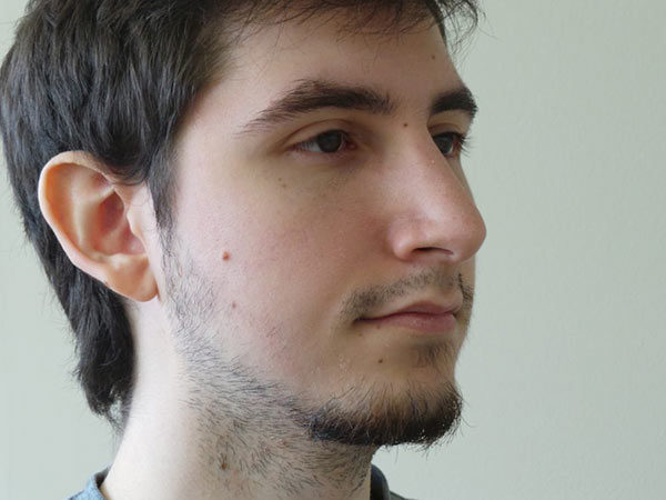 Rhinoplasty Patient 21 After 2