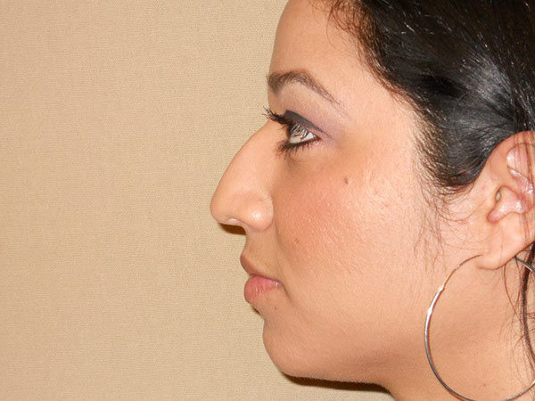 Rhinoplasty Patient 06 Before 1