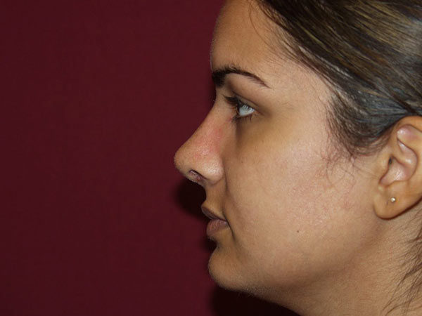 Rhinoplasty Patient 30 After 1
