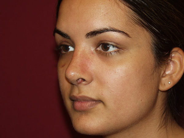 Rhinoplasty Patient 30 After 2