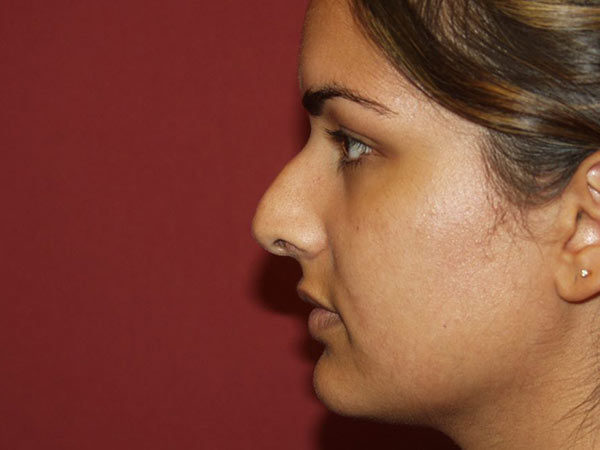 Rhinoplasty Patient 30 Before 1