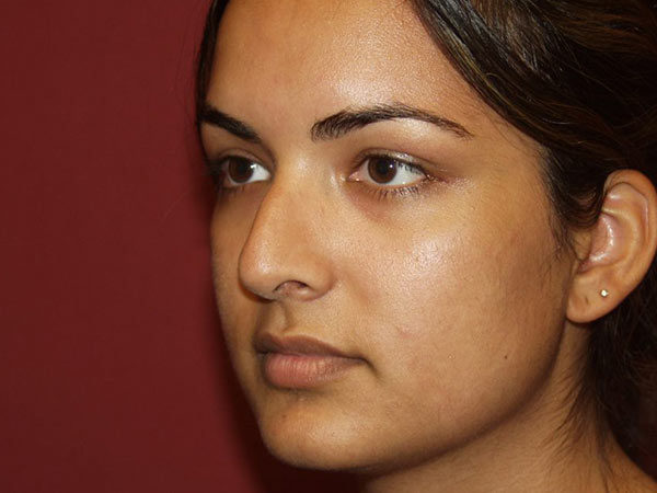 Rhinoplasty Patient 30 Before 2