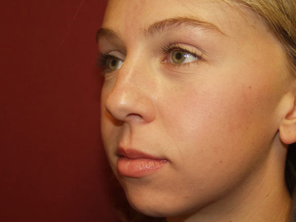 Rhinoplasty Patient 24 Before 1