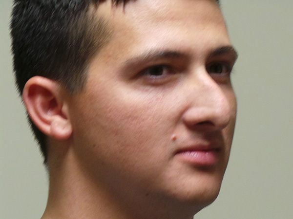 Rhinoplasty Patient 49 Before 1