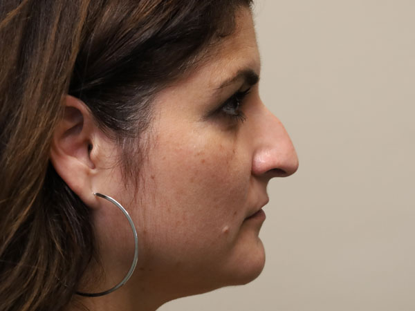 Rhinoplasty Patient 50 Before 1