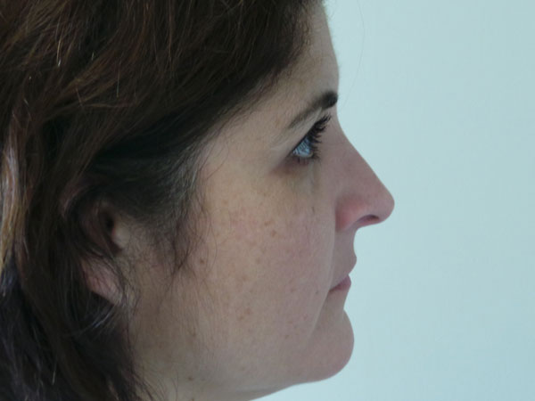 Rhinoplasty Patient 50 After 1