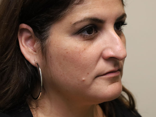 Rhinoplasty Patient 50 Before 2