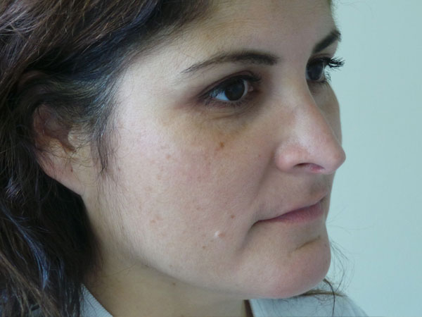 Rhinoplasty Patient 50 After 2