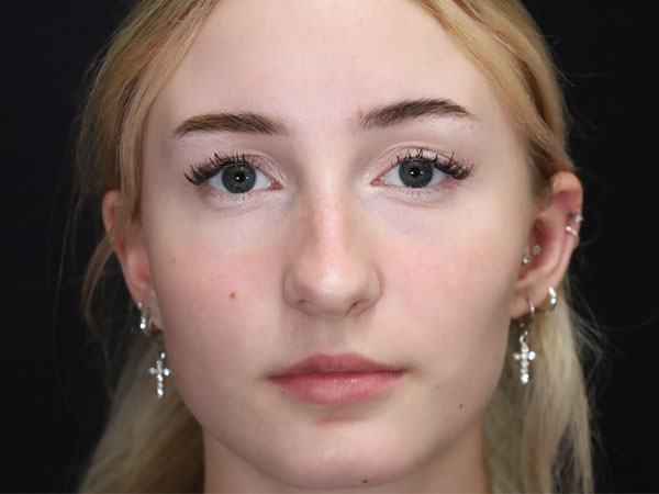 Rhinoplasty Patient 51 Before 3