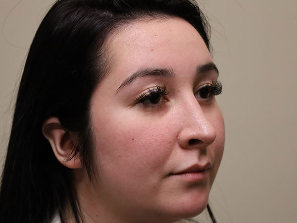 Rhinoplasty Patient 44 After 2