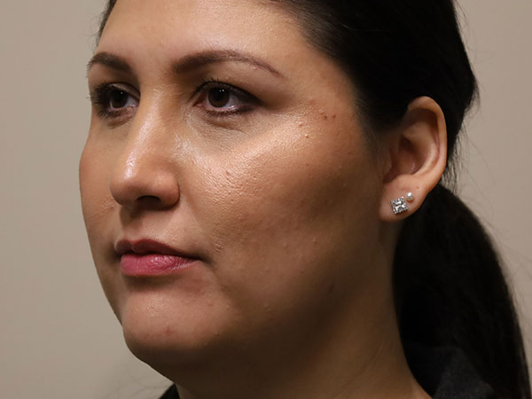 Rhinoplasty Patient 45 After 2