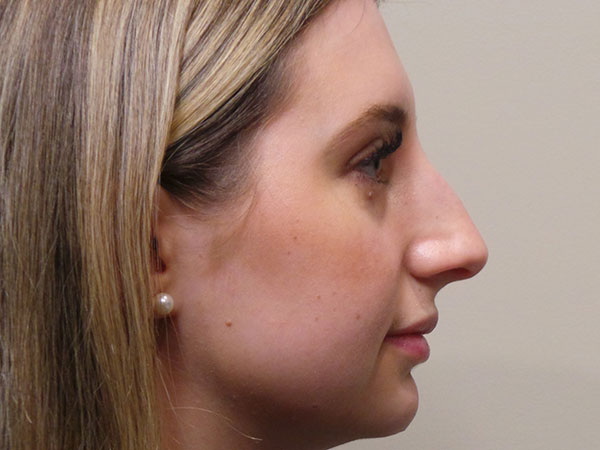 Rhinoplasty Patient 46 Before 1