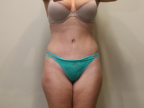 Tummy Tuck Patient 22 After 1