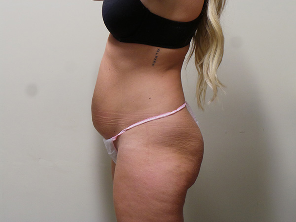 Tummy Tuck Patient 22 Before 2