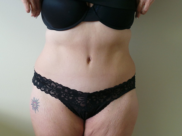 Tummy Tuck with Lipo Patient 1 Before 1