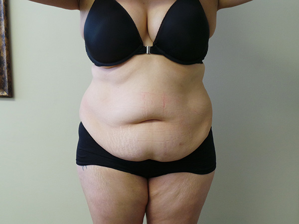 Tummy Tuck with Lipo Patient 1 After 1