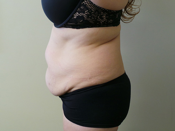 Tummy Tuck with Lipo Patient 1 Before 2