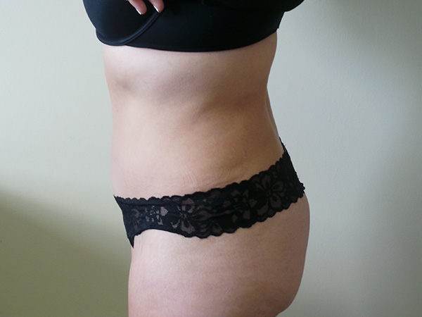 Tummy Tuck with Lipo Patient 1 After 2